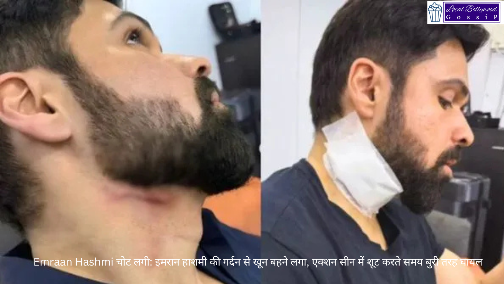 Emraan Hashmi चोट लगी: इमरान हाशमी की गर्दन से खून बहने लगा, एक्शन सीन में शूट करते समय बुरी तरह घायल